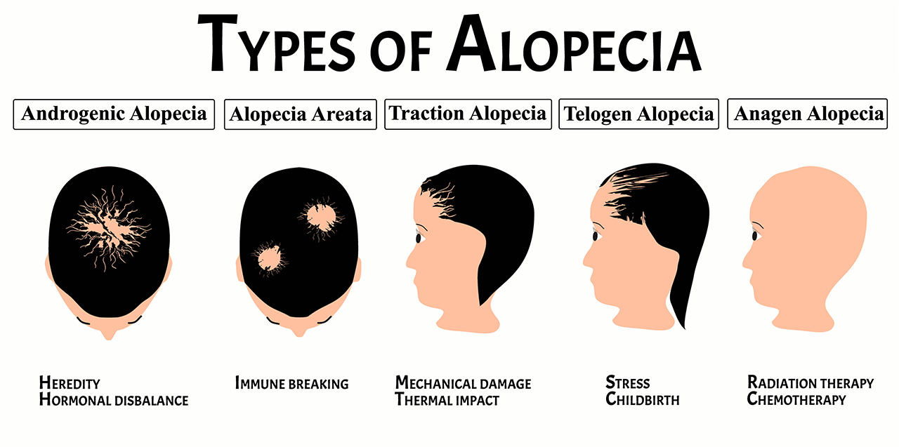 Types of Alopecia | R Spa Balaros